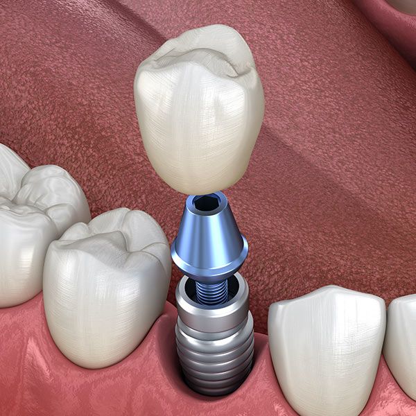 Dental Implants