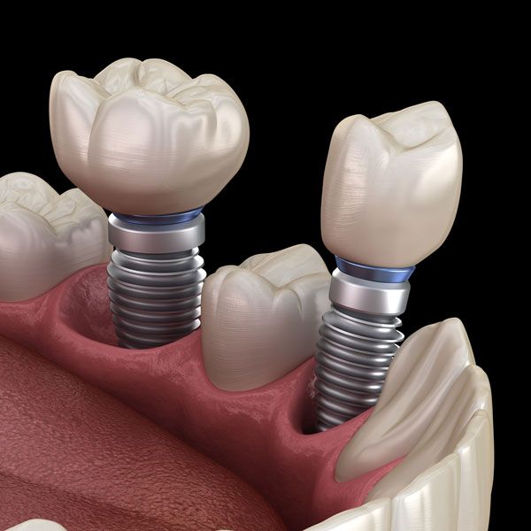 Implant crowns