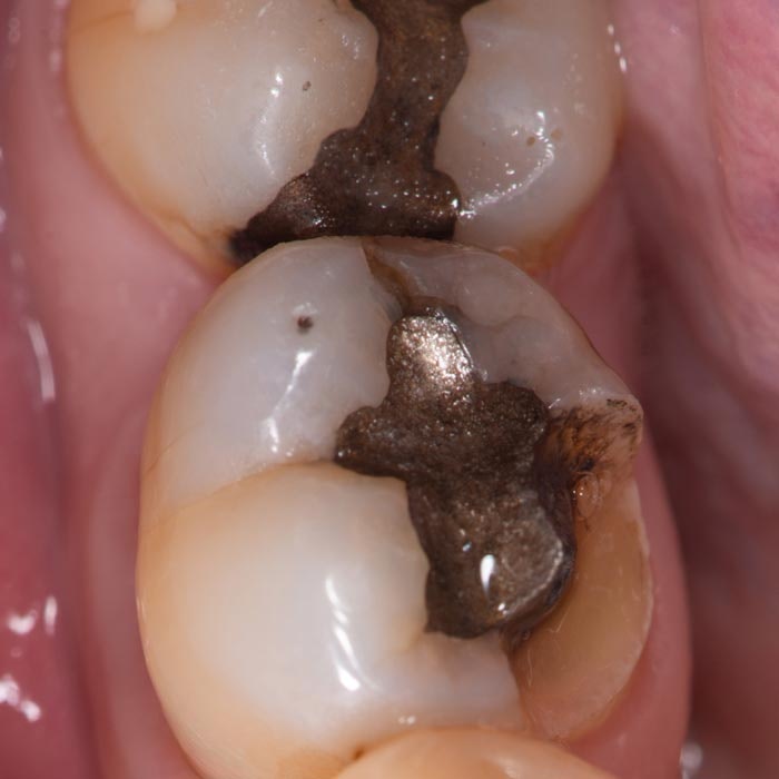 Tooth with Silver Filling