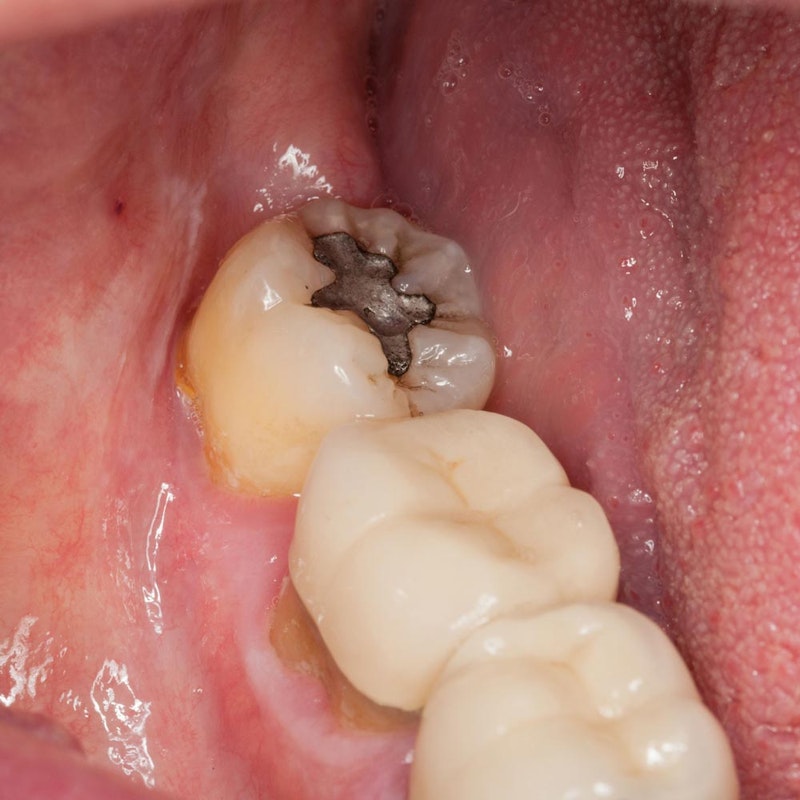 A decaying tooth