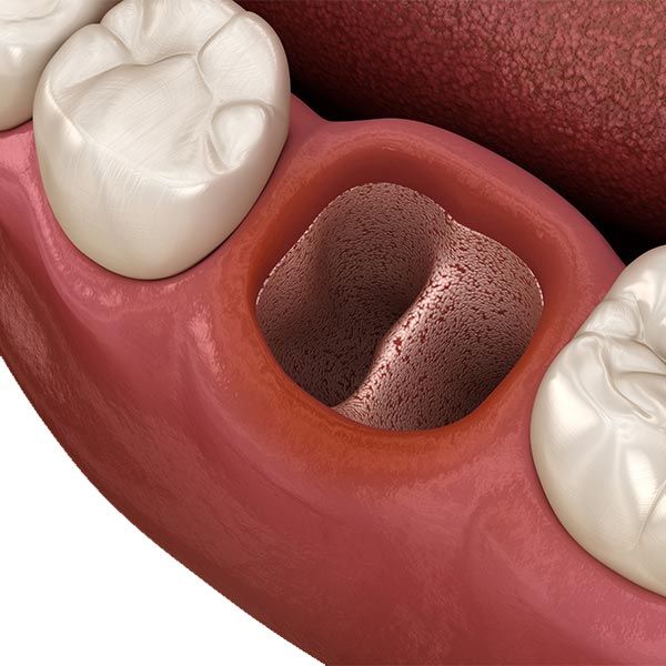 Illustration of an empty tooth socket